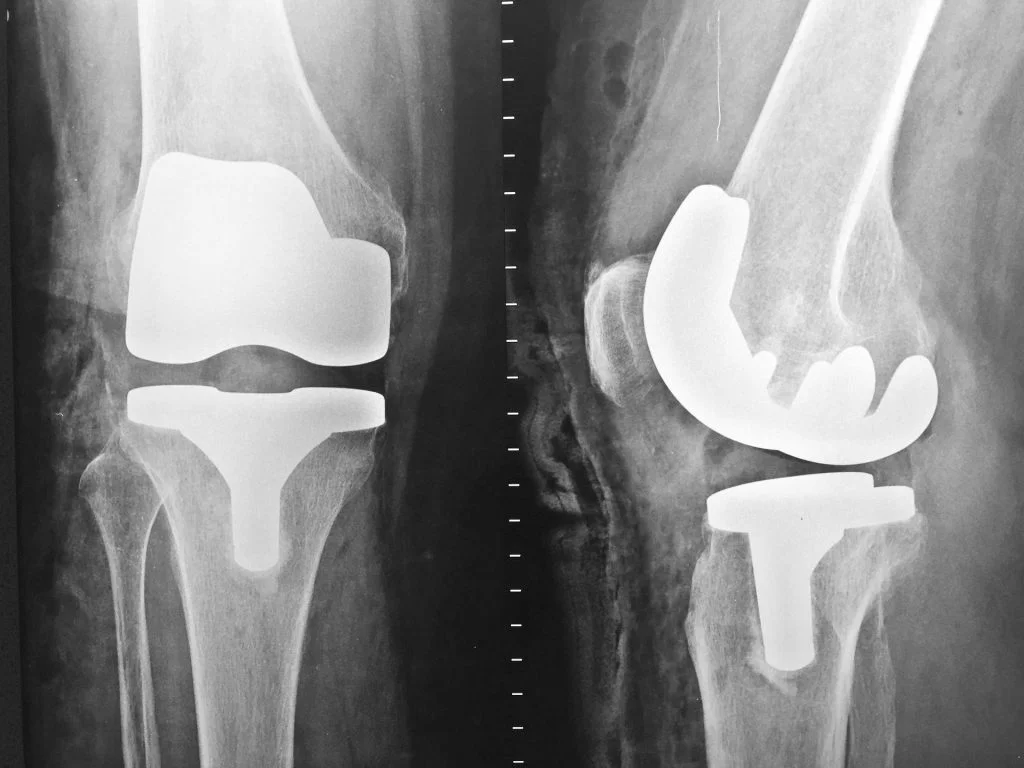 radiografie articulatie proteza