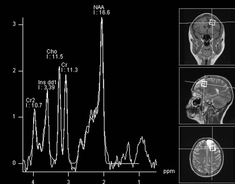 spectroscopie rmn cerebral