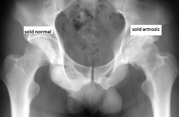 Radiografie pentru durerea articulației șoldului