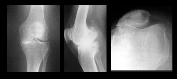 Radiografie a genunchiului în artrita reumatoidă